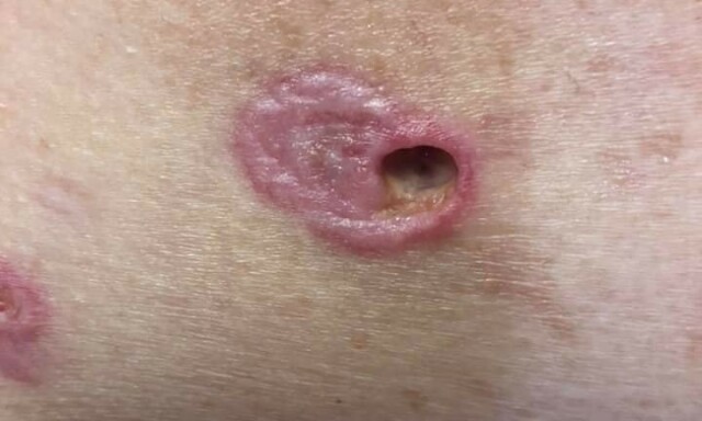 PYODERMA GANGRENOSUM: Sår med dypt hull etter at det er tatt vevsprøve (biopsi). Foto: Privat, pasienten har samtykket til publiseringen. PYODERMA GANGRENOSUM: Sår med dypt hull etter at det er tatt vevsprøve (biopsi). Foto: Privat, pasienten har samtykket til publiseringen.